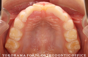 子役の歯並び症例